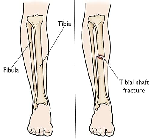 Tibia brace For Leg, calf and Fibula Fracture Support - DEBIK